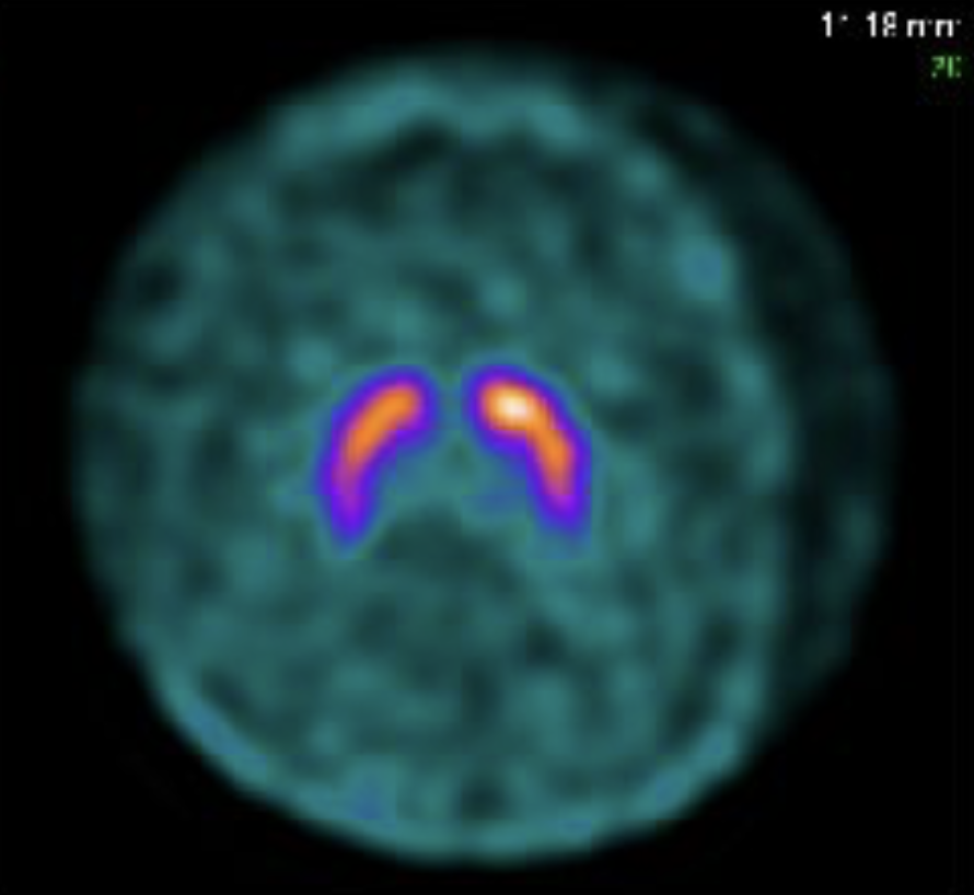 False-color clinical imaging display with a teal circular field and two mirrored orange-and-purple highlighted regions near the center.